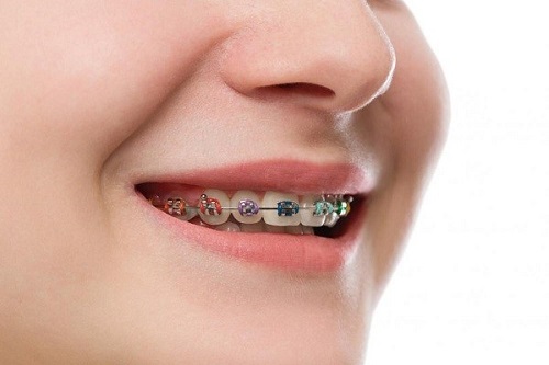 Niềng răng chữa cười hở lợi hiệu quả không? Kết quả từ nha khoa