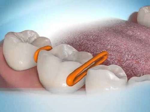 Niềng răng gia đoạn nào đau nhất? Cần phải kiêng cử gì khi niềng răng