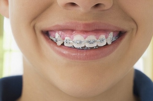 Niềng răng gia đoạn nào đau nhất? Cần phải kiêng cử gì khi niềng răng