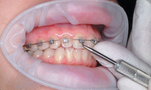 Niềng răng hàm trên mất bao lâu là có kết quả như ý?