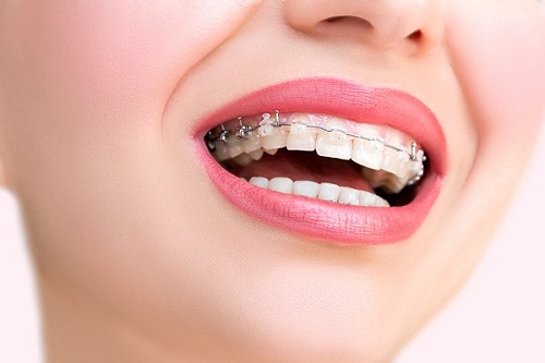 Niềng răng hàm trên mất bao lâu là có kết quả như ý?
