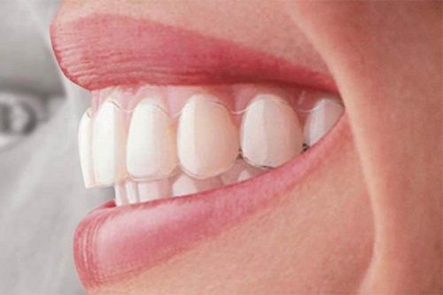 Niềng răng không mắc cài mất bao lâu là xong?