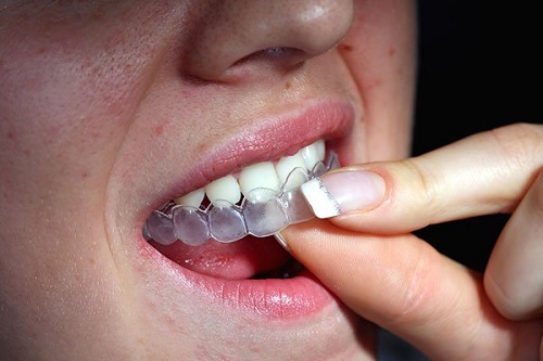 Niềng răng làm răng lung lay phải xử lý ra sao?
