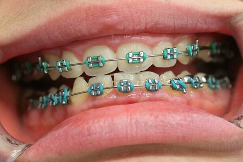 Niềng răng làm răng lung lay phải xử lý ra sao?