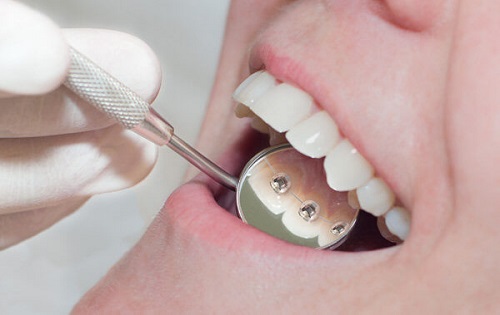 Niềng răng mặt trong có đau không? Tìm hiểu thực tế từ nha khoa