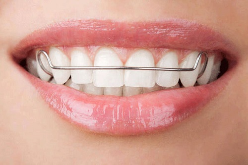 Tìm hiểu - Niềng răng phải đeo hàm duy trì bao lâu?