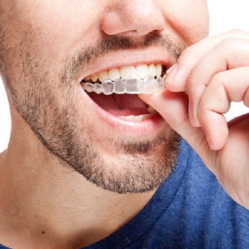 Niềng răng tháo lắp có tốt không? Nha khoa giải đáp
