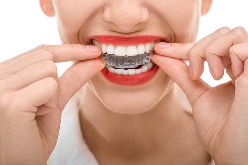 Niềng răng trong suốt có hiệu quả không? Tìm hiểu về phương pháp này