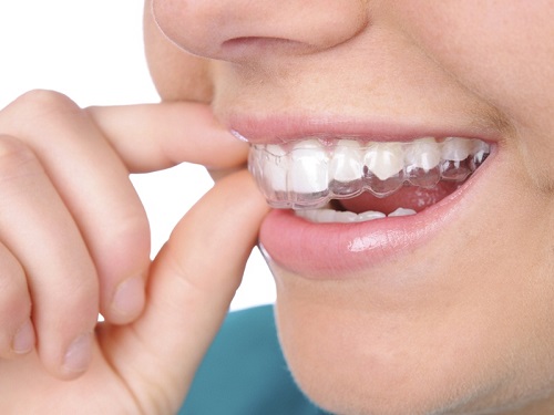 Niềng răng trong suốt có phải nhổ răng không? Nha khoa tư vấn
