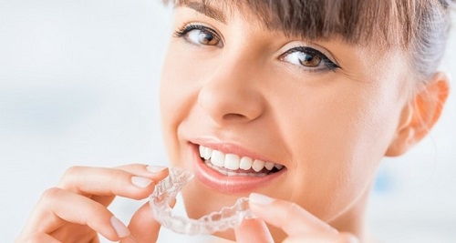 Niềng răng trong suốt mất bao lâu? Có phụ thuộc vào yếu tố nào không?
