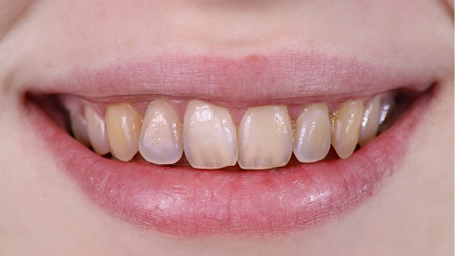 3 Tác hại của việc tẩy trắng răng - Tìm hiểu không hối hận 1