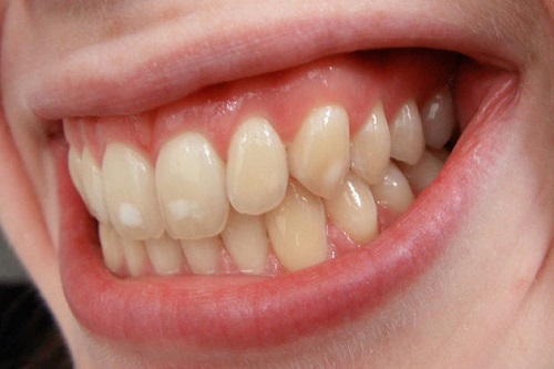 3 Tác hại của việc tẩy trắng răng - Tìm hiểu không hối hận 2