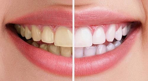 3 Tác hại của việc tẩy trắng răng - Tìm hiểu không hối hận 3