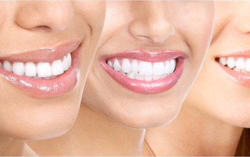 Tẩy trắng răng có ảnh hưởng gì không? Nha khoa tư vấn 1
