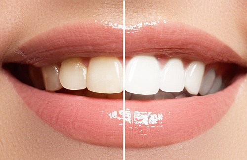 Tẩy trắng răng có ảnh hưởng gì không? Nha khoa tư vấn 3