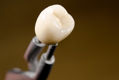 Bọc răng sứ có ảnh hưởng gì không? Lợi ích khi bọc răng sứ