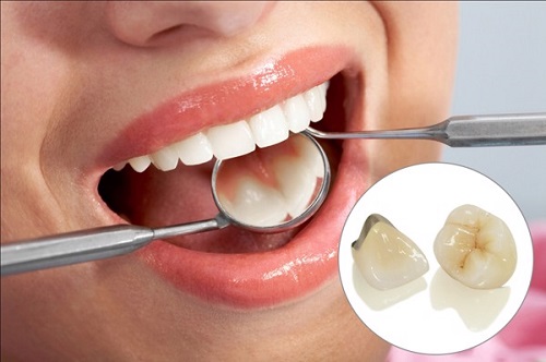 Có nên bọc răng sứ kim loại thường không?