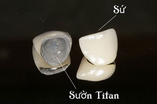 Có nên bọc răng sứ kim loại thường không?