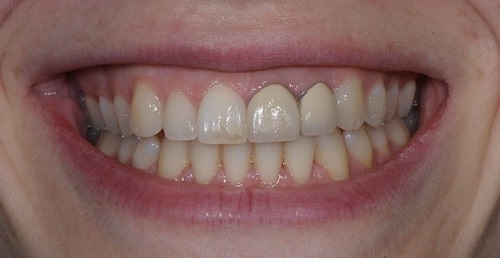 Có nên trồng răng sứ kim loại không? Ưu điểm của răng sứ kim loại