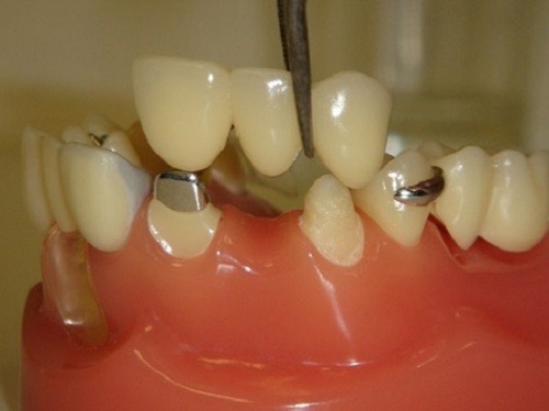 Kỹ thuật trồng răng sứ được thực hiện qua mấy bước?