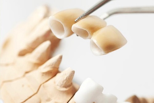 Kỹ thuật trồng răng sứ được thực hiện qua mấy bước?