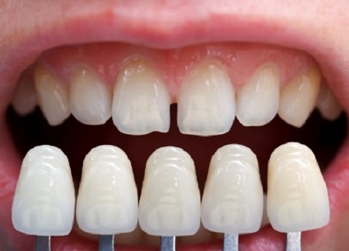 Thông tin cần biết trước khi làm răng sứ cả hàm