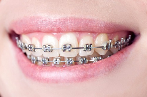 Niềng răng lệch nhân trung - Một số điều cần biết trước khi niềng răng