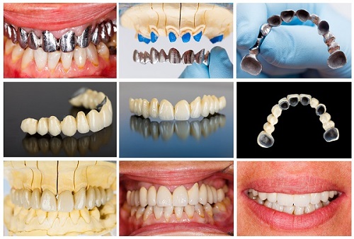 Tình trạng răng sứ bị nứt phải làm sao?