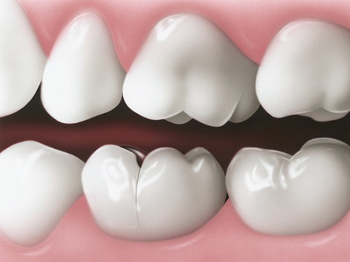 Tình trạng răng sứ bị nứt phải làm sao?