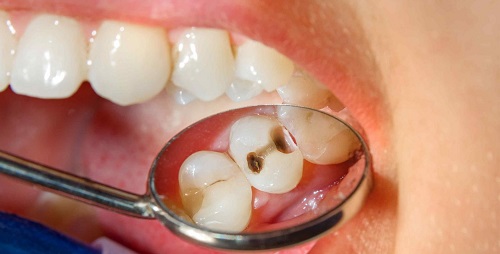 Răng sứ có bị sâu không? Nha khoa giải đáp
