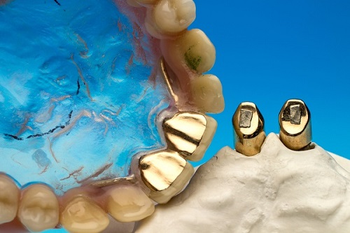 Răng sứ gây hôi miệng - Nguyên nhân chính do đâu?