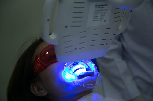 Tẩy trắng răng bằng đèn plasma có hại không? Xác minh từ nha khoa 2
