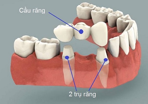 Trồng răng bằng cầu răng - Cách thực hiện và ưu điểm dịch vụ