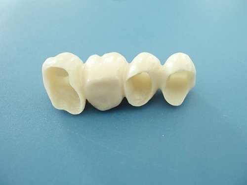 Trồng răng cửa hàm trên nên áp dụng kỹ thuật nào?