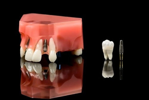 Trồng răng giả có niềng được không? Lý giải từ nha khoa