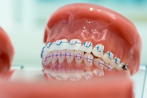Trồng răng giả có niềng được không? Lý giải từ nha khoa