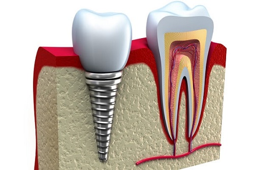 Trồng răng hàm implant giá bao nhiêu? Bảng giá mới nhất