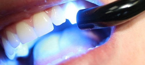 Trồng răng khểnh có đau không? Quy trình thực hiện