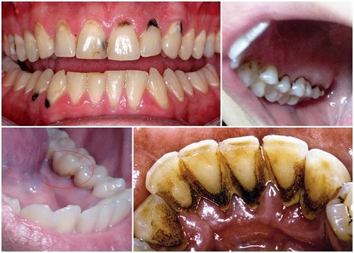 Trồng răng sứ bị đen chân răng - Nguyên nhân do đâu
