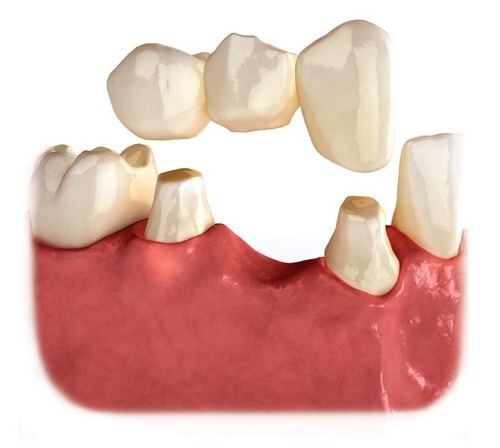Trồng răng sứ bị nhức - Nguyên nhân và cách khắc phục