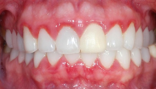 Trồng răng sứ bị nhức - Nguyên nhân và cách khắc phục