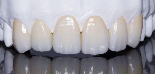 Trồng răng sứ có bị hôi miệng không? Cách chăm sóc răng sau khi phục hình