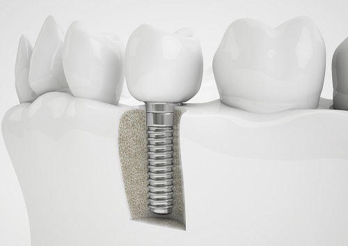 Trồng răng sứ có bị hôi miệng không? Cách chăm sóc răng sau khi phục hình
