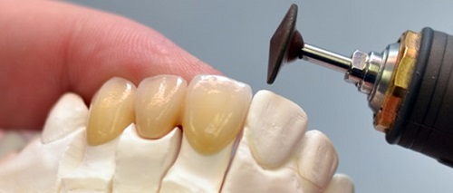 Trồng răng sứ có đau không? 3 lưu ý khi trồng răng