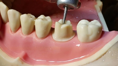 Trồng răng sứ có đau không? 3 lưu ý khi trồng răng