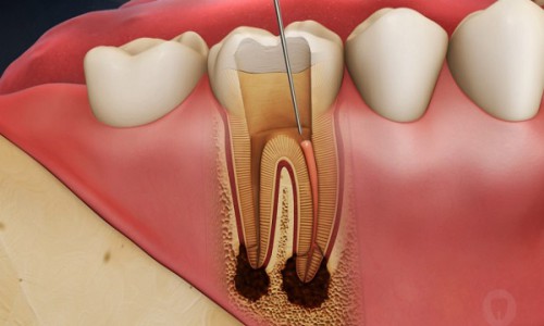 Trồng răng sứ có phải lấy tủy không? Tìm hiều kỹ thuật phục hình