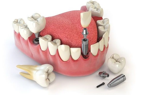 Trồng răng sứ có tháo ra được không? Nên tháo ra trong trường hợp nào?