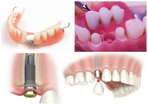 Quá trình trồng răng sứ mất thời gian bao lâu là hoàn thành?
