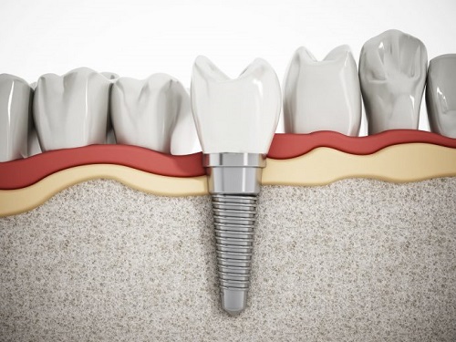 Quá trình trồng răng sứ mất thời gian bao lâu là hoàn thành?