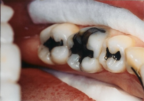 Bọc răng hàm bị sâu có đau không? Tìm hiểu cách thực hiện